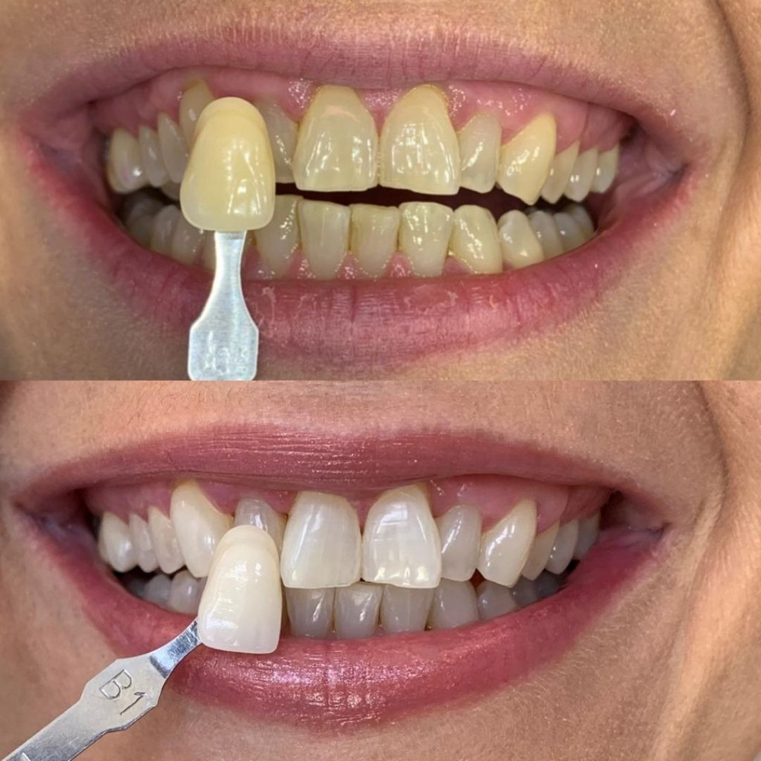 Tooth Whitening 