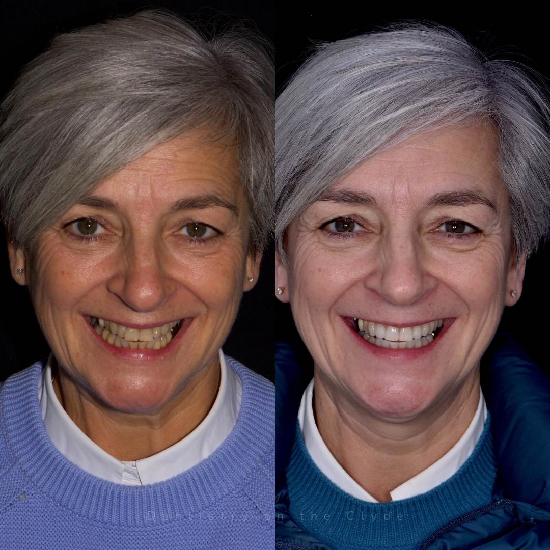 Dentistry On The Clyde | Request A Complimentary Consultation Before and after treatment at Dentistry On The Clyde in Gourock