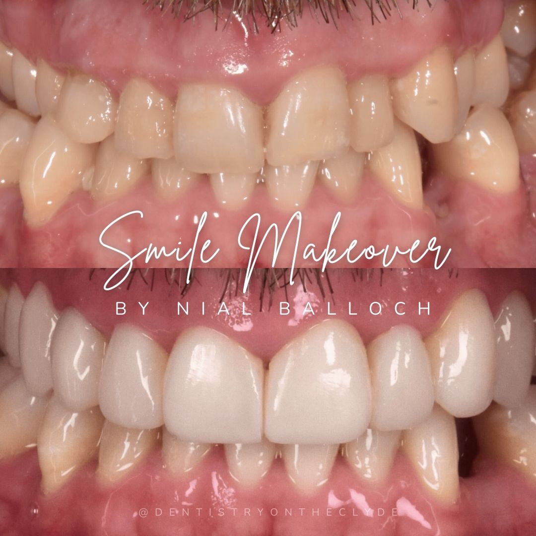 Dentistry On The Clyde | Request A Complimentary Consultation Before and after treatment at Dentistry On The Clyde in Gourock