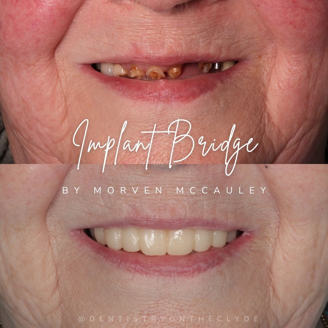 Dentistry On The Clyde | Request A Complimentary Consultation Before and after treatment at Dentistry On The Clyde in Gourock