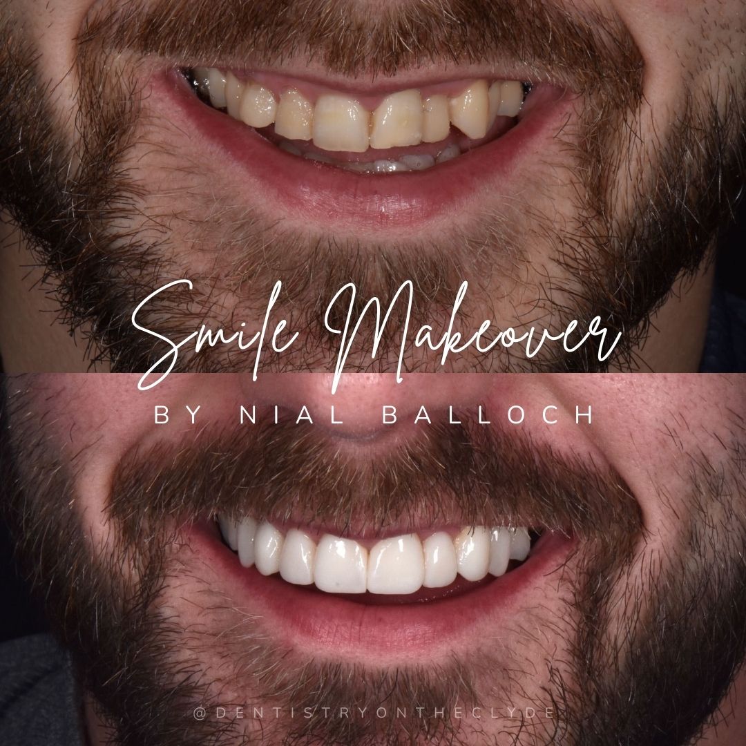 Dentistry On The Clyde | Request A Complimentary Consultation Before and after treatment at Dentistry On The Clyde in Gourock